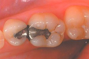 Inlays : Hochwertige Zahnfüllung bei Defekten - Zbz