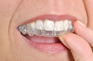 Unsichtbare Zahnspange Zahnarzt P Tomovic Asthetische Zahnheilkunde In Frankfurt Westend