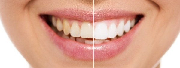 Ein strahlend weißes Lächeln von Zahnarztpraxis P. Tomovic in Frankfurt Westend